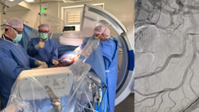 Erster minimalinvasiver Eingriff mit individuell gefertigter fenestrierter Aortenprothese